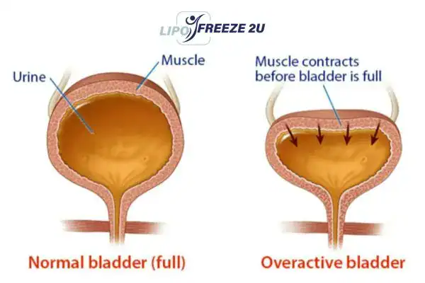 diagram of overactive bladder treatment Barry