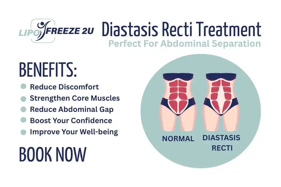 Benefits of body toning treatment Barry for Diastasis recti
