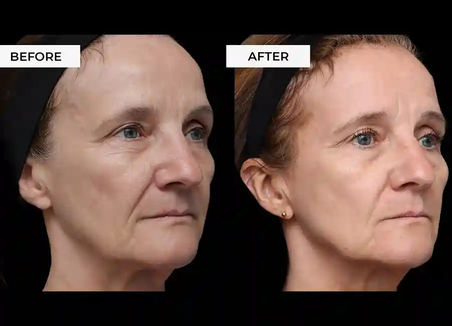 How Many RF Microneedling Sessions Will You Need to See a Difference Barry?