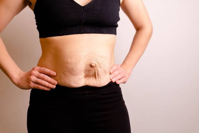Is Surgery Really the Only Way to Repair Diastasis Recti Barry?