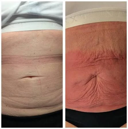 How Does RF Microneedling Improve Crepey, Thin and Uneven Skin Texture Barry?
