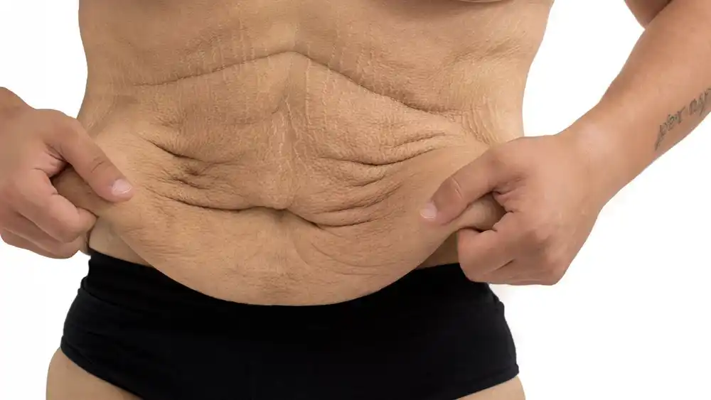RF Microneedling for Loose Skin: How Can It Help Tighten and Reshape the Skin Barry?